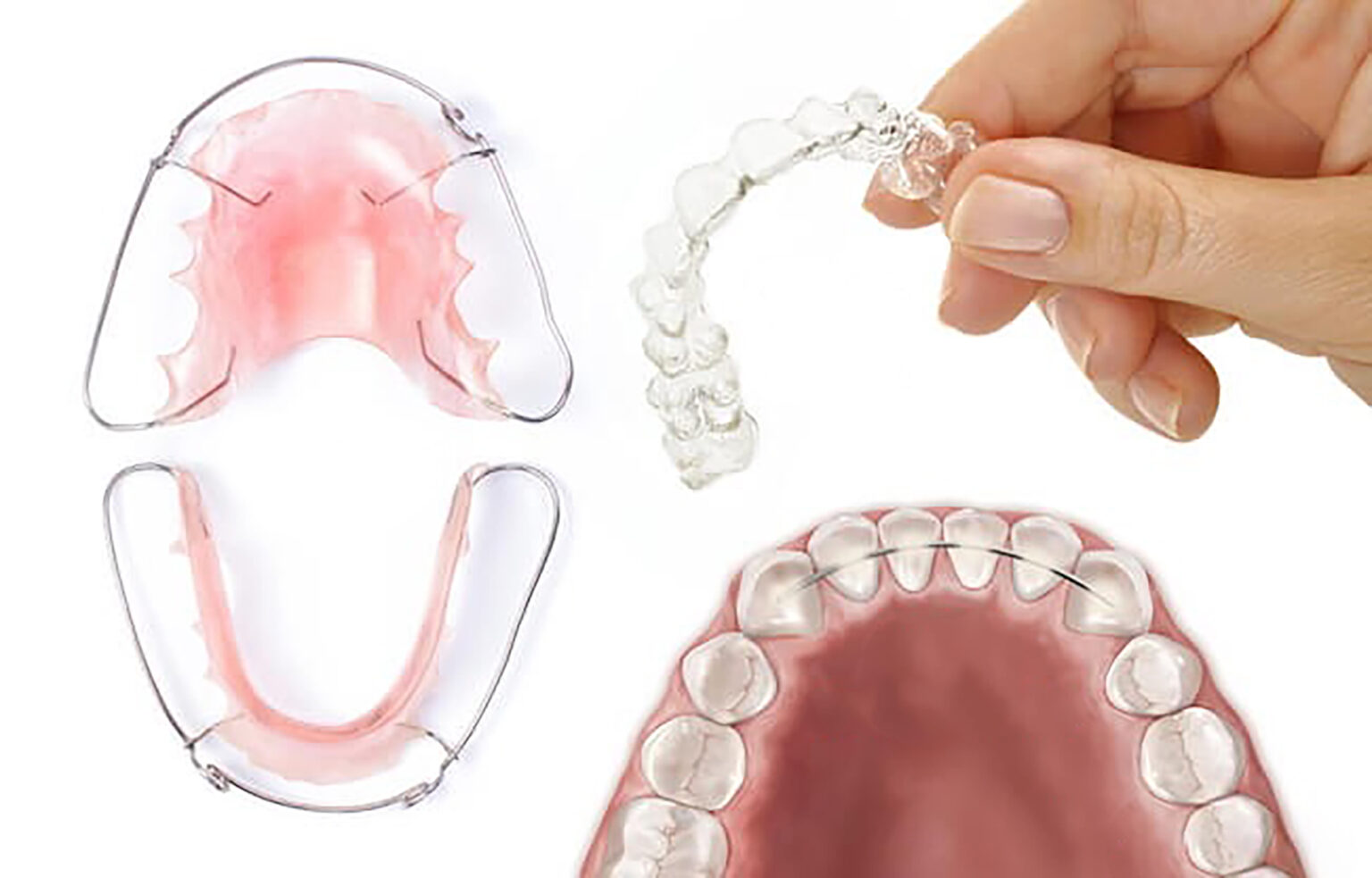 Retainer After Rpe Wearing A Retainer After Orthodontic Treatment - TGO orthodontics ...