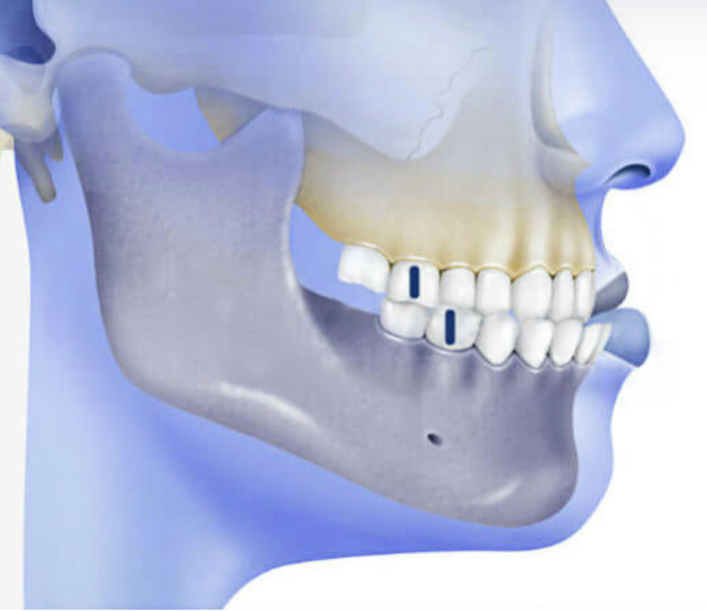 Illustration de profil d'une malocclusion de classe III, dans laquelle la mâchoire inférieure est avancée par rapport à la mâchoire supérieure, ce qui entraîne un surplomb horizontale négatif. Ce type de développement est fréquent chez les enfants en pleine croissance et peut bénéficier d'une intervention orthodontique précoce.